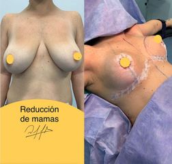 Reducción mamaria - Dr. Diego Polanco