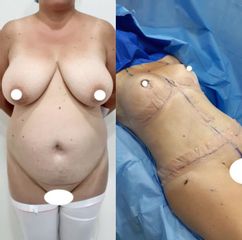 Lipoescultura - Dr. Diego Polanco