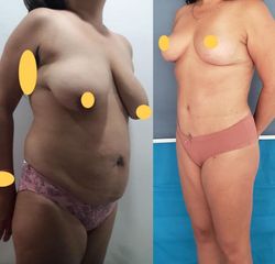 Abdominoplastia - Dr. Diego Polanco