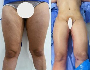 Cruroplastia o Lifting de muslos
