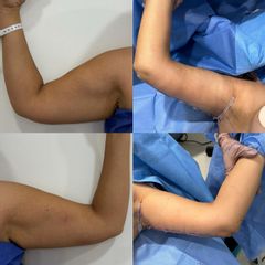 Braquioplastia - Dr. Diego Polanco