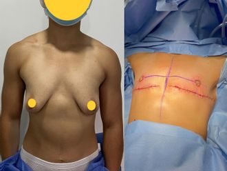 Reasignación de sexo antes y después - 862546