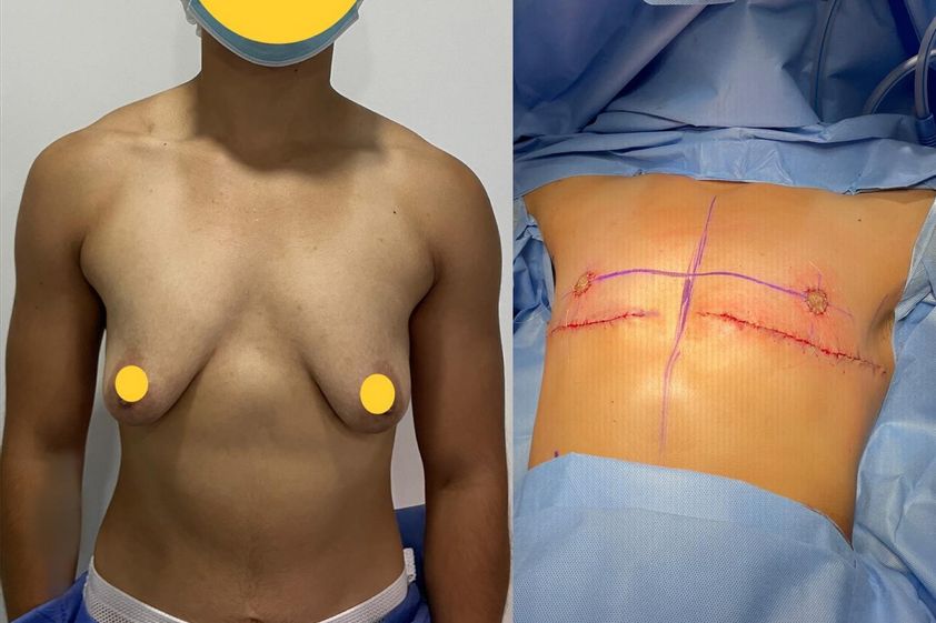 Reasignación de sexo antes y después - 862546