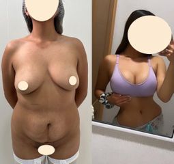 Abdominoplastia - Dr. Diego Polanco