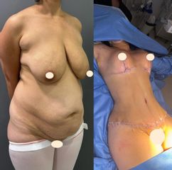 Abdominoplastia - Dr. Diego Polanco
