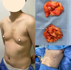 Ginecomastia - Dr. Diego Polanco