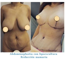 Abdominoplastia - Dr. Diego Polanco