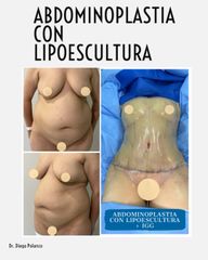 Abdominoplastia - Dr. Diego Polanco