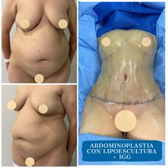 Abdominoplastia - Dr. Diego Polanco