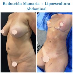 Abdominoplastia - Dr. Diego Polanco