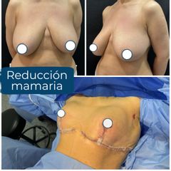 Reducción mamaria - Dr. Diego Polanco