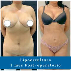 Lipoescultura - Dr. Diego Polanco