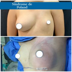 Reconstrucción mamaria - Dr. Diego Polanco