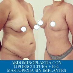 Abdominoplastia - Dr. Diego Polanco