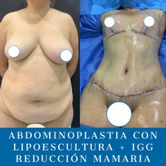 Abdominoplastia - Dr. Diego Polanco