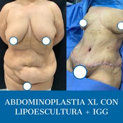 Abdominoplastia - Dr. Diego Polanco
