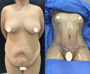 Abdominoplastia - Dr. Diego Polanco