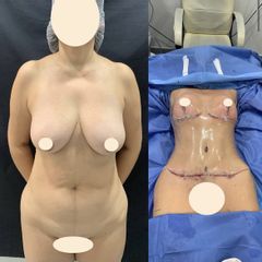 Abdominoplastia - Dr. Diego Polanco