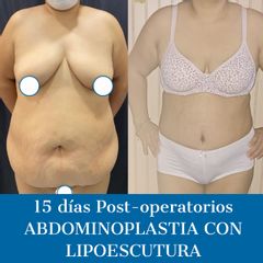 Abdominoplastia - Dr. Diego Polanco