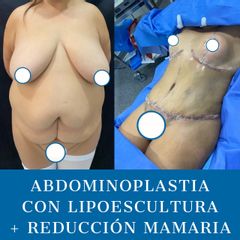 Reducción mamaria - Dr. Diego Polanco