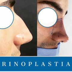 Rinoplastia - Dr. Diego Polanco