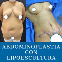 Abdominoplastia - Dr. Diego Polanco