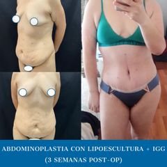 Abdominoplastia - Dr. Diego Polanco
