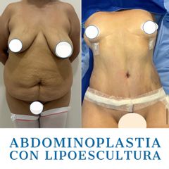 Abdominoplastia - Dr. Diego Polanco