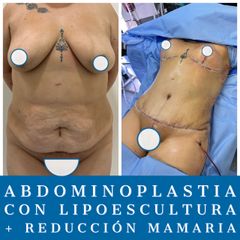 Abdominoplastia - Dr. Diego Polanco