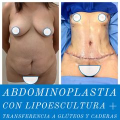 Abdominoplastia - Dr. Diego Polanco
