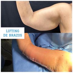 Lifting - Dr. Diego Polanco