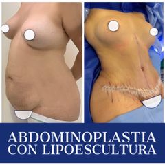 Abdominoplastia - Dr. Diego Polanco