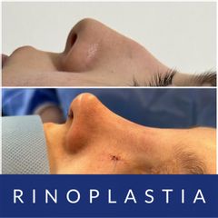 Rinoplastia - Dr. Diego Polanco