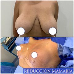 Reducción mamaria - Dr. Diego Polanco