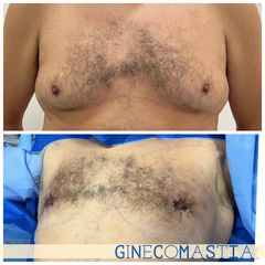 Ginecomastia - Dr. Diego Polanco