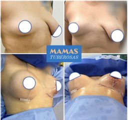 Aumento mamario - Dr. Diego Polanco