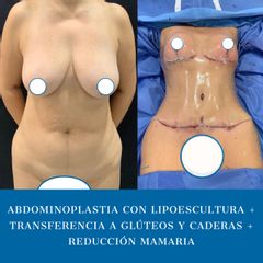 Abdominoplastia - Dr. Diego Polanco