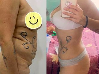Liposucción antes y después - 880900