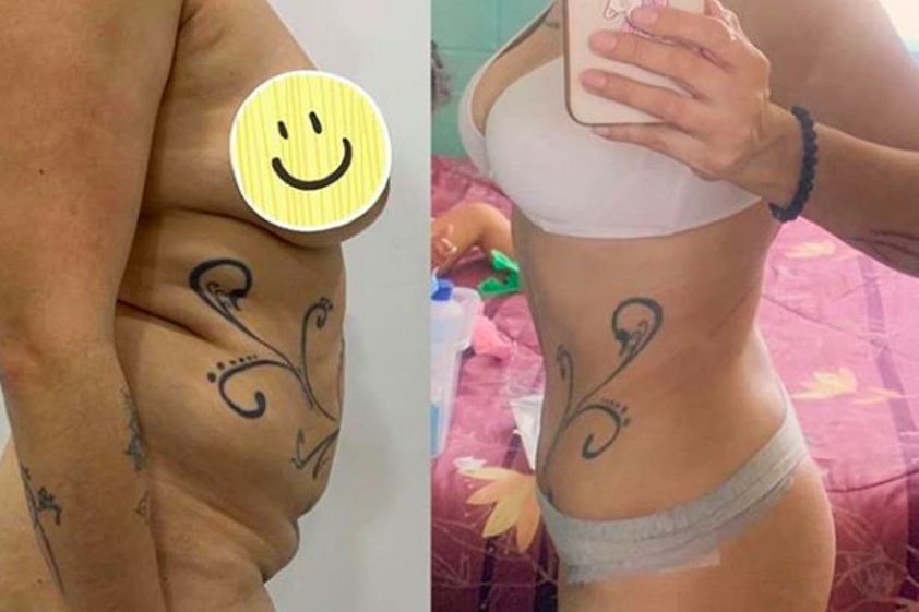 Liposucción antes y después - 880900