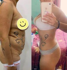 Liposucción - Dr. Diego Polanco