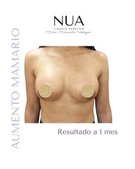 Dra. Daniela Ferreyra - Aumento mamario