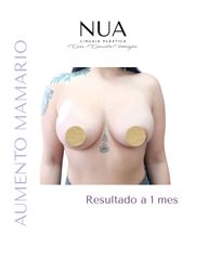 Dra. Daniela Ferreyra - Aumento mamario
