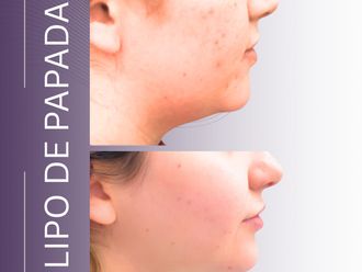 Lipopapada antes y después - 880415