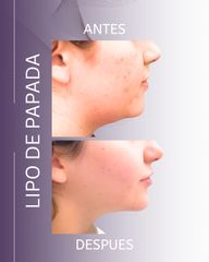 Lipopapada - Dra. Daniela Ferreyra