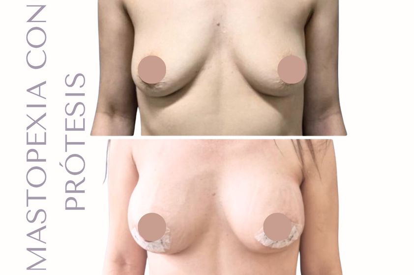 Mastopexia antes y después - 880416
