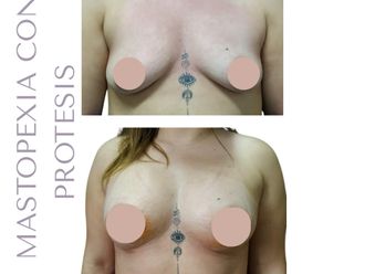 Mastopexia antes y después - 880417