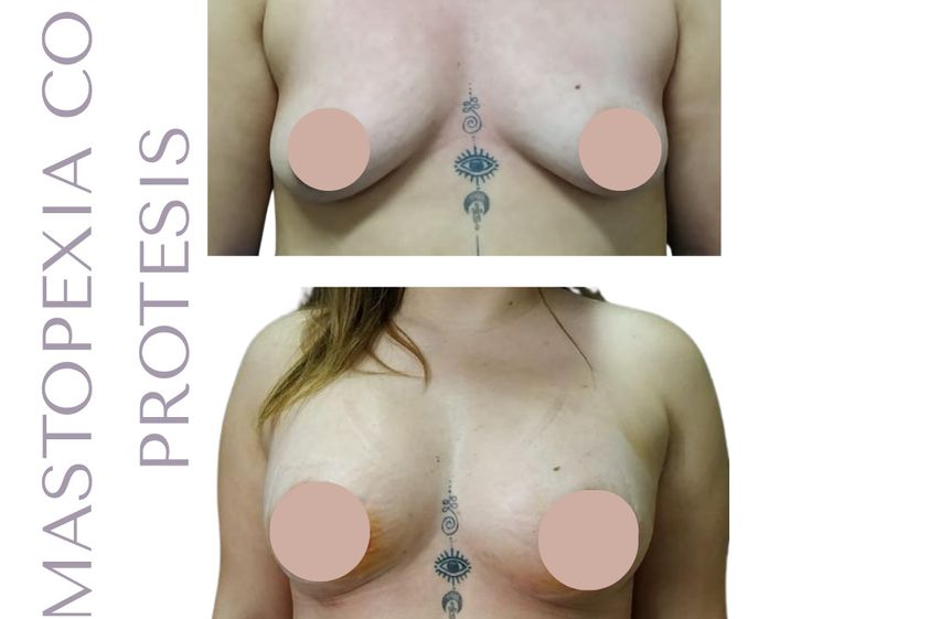 Mastopexia antes y después - 880417