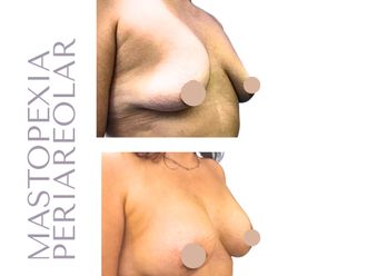 Mastopexia antes y después - 880418