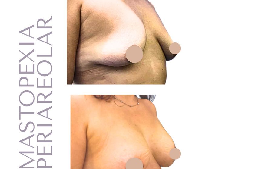 Mastopexia antes y después - 880418