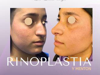 Rinoplastía antes y después - 880419